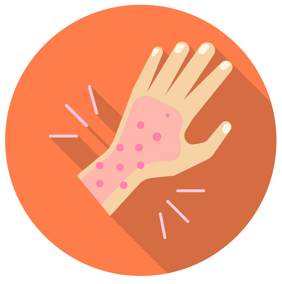 Obrazek przedstawiający dłoń osoby chorej mająca wysypkę na skutek alergii. Jest to odniesienie do usługi deakaryzacji poprzez Ozonowanie Szczecin.